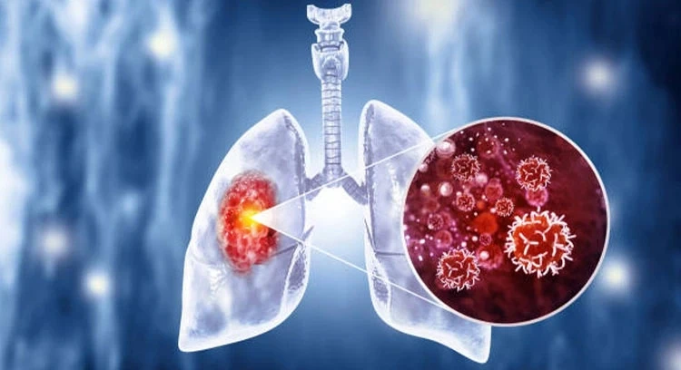 Recognising Early Signs of Lung Cancer: Navigating the Best Lung Cancer Treatment in UAE 