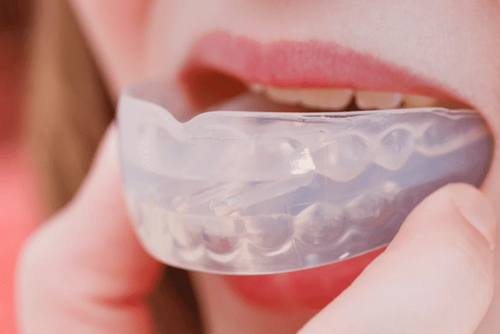 What Are Sports Mouthguards, and Why Are They Important?