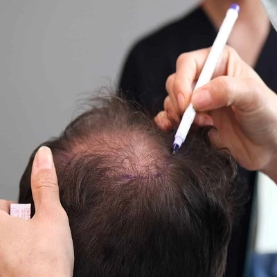 How Does Hair Transplantation Transform Thinning Hair Into a Thicker Look?: