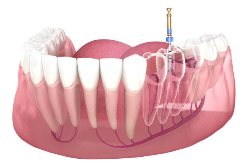 How Long Does a Tooth Last After a Root Canal?