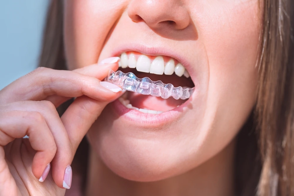 How Invisalign Works: A Step-by-Step Guide for First-Time Patients