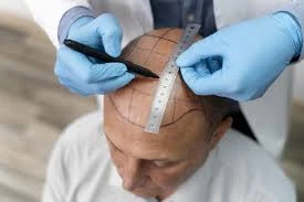 Get Long-Lasting Solutions for Hair Thinning Problems with Advanced DHI Transplant