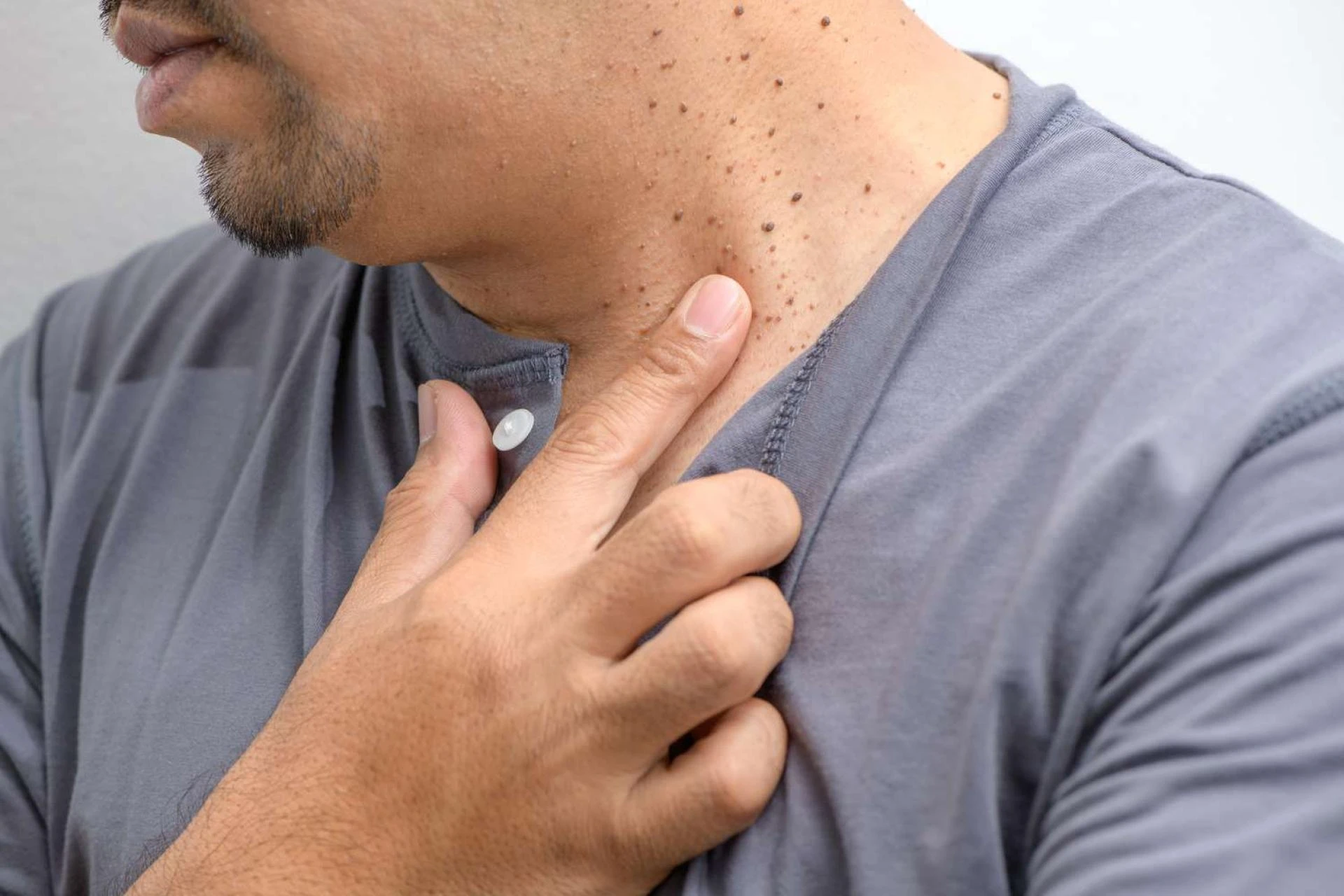Are Skin Tags Contagious? When to Worry and When Not To