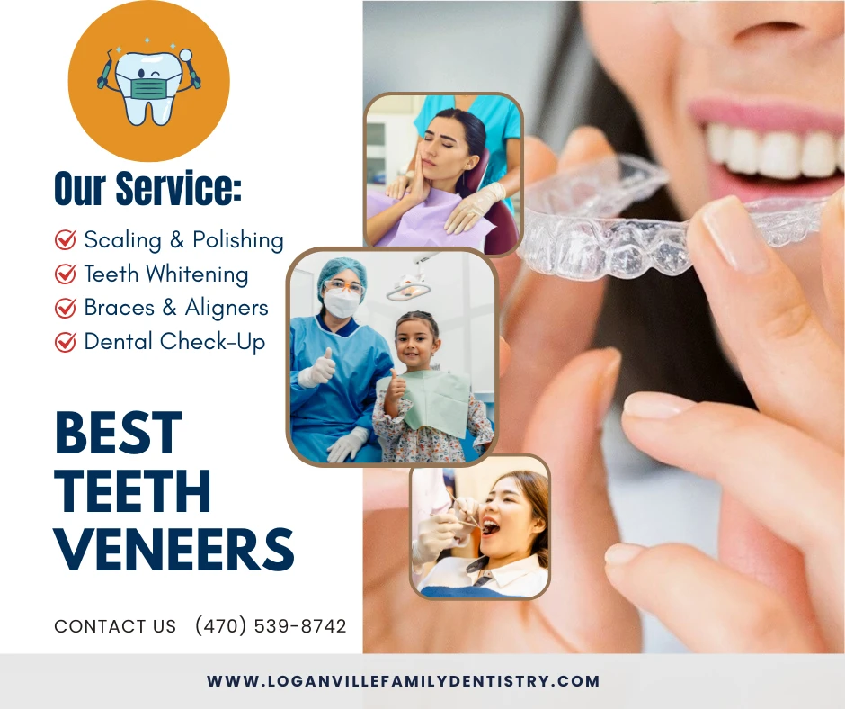 Best Teeth Veneers: Transform Your Smile with Natural-Looking Results