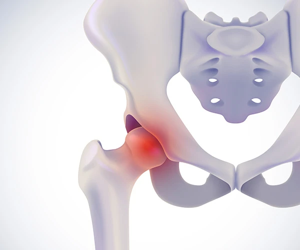 What is Avascular Necrosis (AVN)?