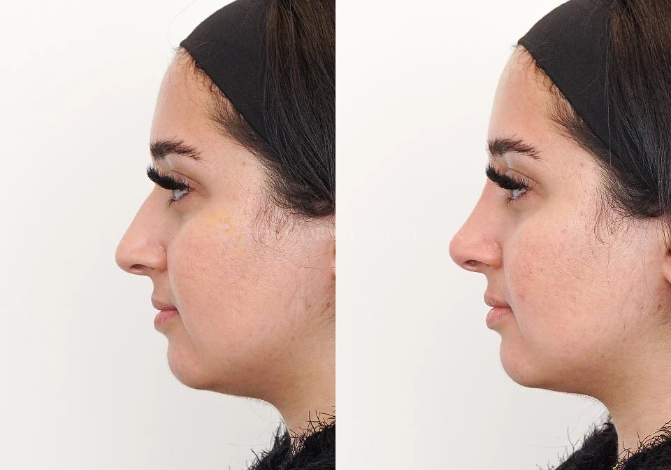 Can a Non-Surgical Nose Job Fix a Droopy Tip?