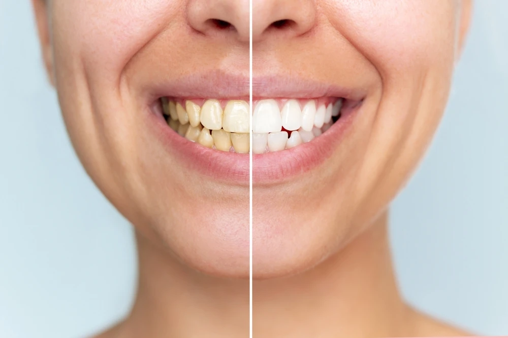 Teeth Whitening: How to Get a Brighter, Healthier Smile