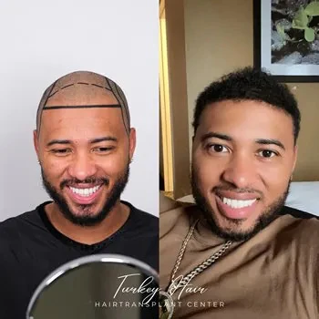 Hair Loss Affects Hair Transplant in Turkey