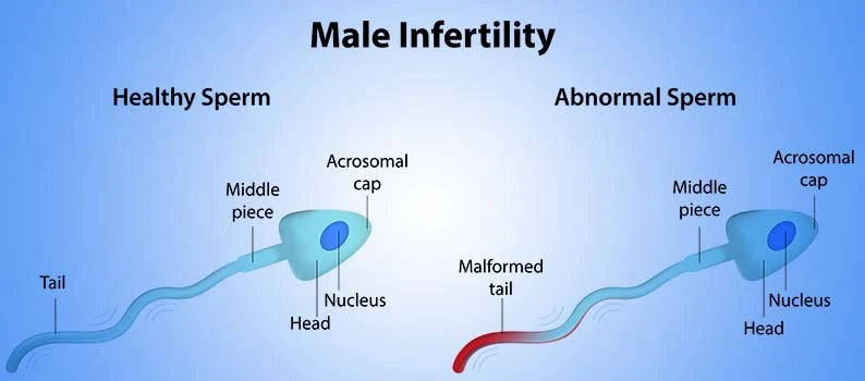 What is Male Infertility Treatment?