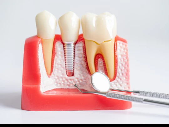 Root Canal Therapy: Step-by-Step Procedure Explained