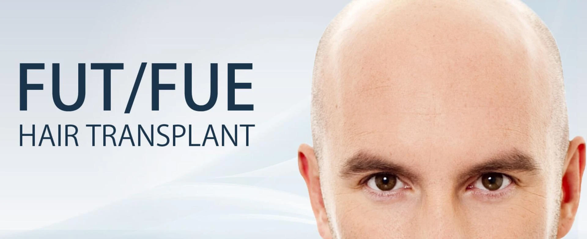 Everything You Need To Know About Hair Transplant