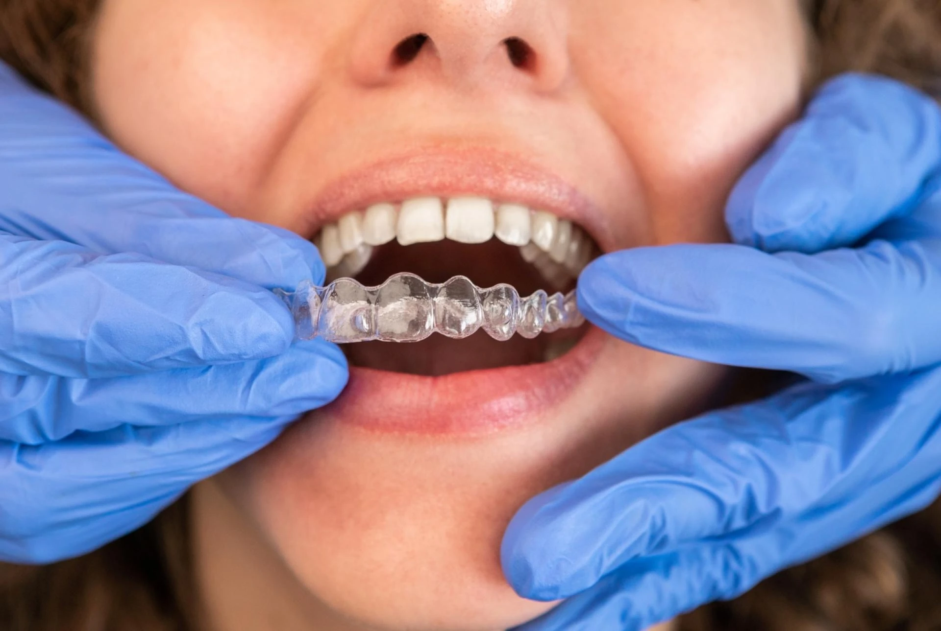 Clear Aligners and Your Lifestyle  Eat, Clean, Smile Without Worries