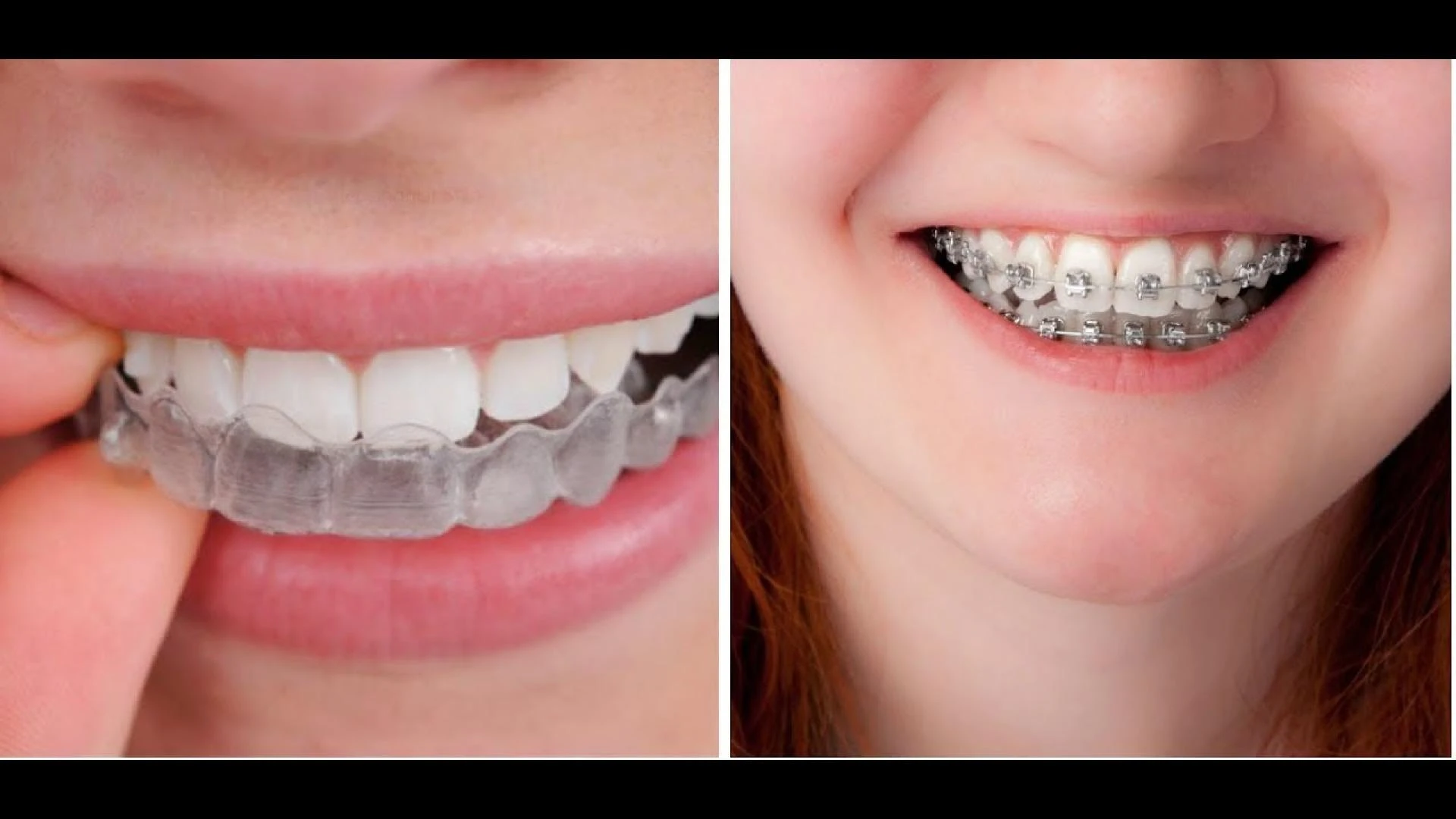 Braces vs. Invisalign in Dallas: Which Orthodontic Option Is Right for You?