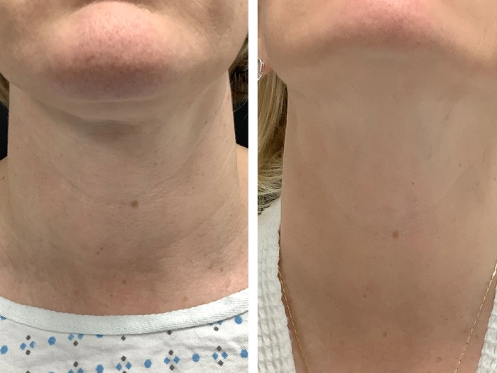 Precision Treatment by Radiofrequency (RF) Microneedling Best Doctors in Dubai