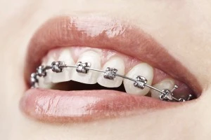 A Complete Guide to Braces: Achieving a Straighter, Healthier Smile with Orthodontics