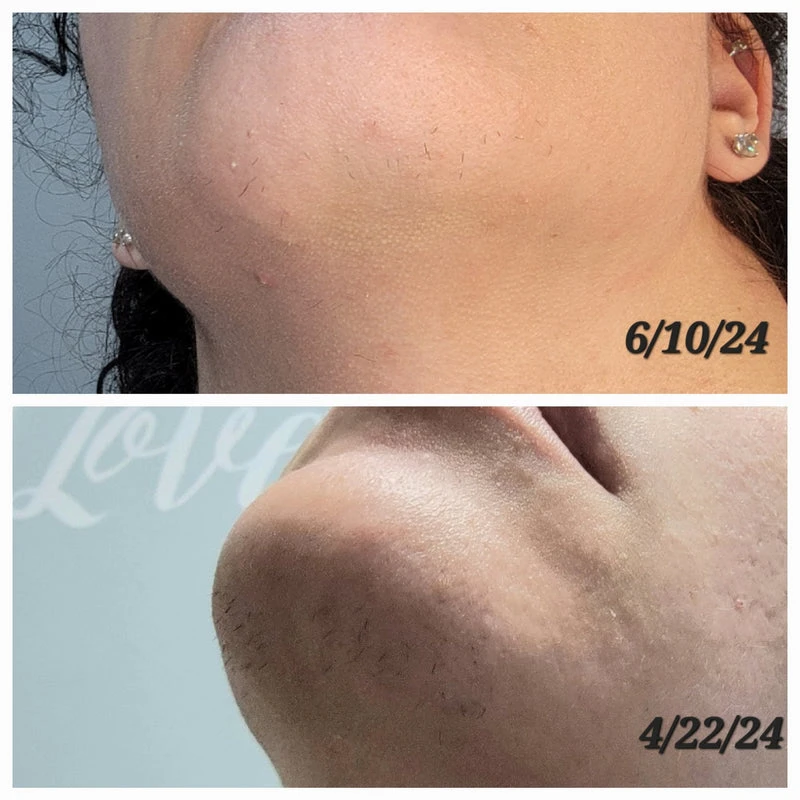 Book Your Laser Hair Removal Session Today at Frisco’s Trusted Clinic