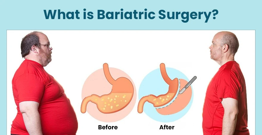 What Is Bariatric Surgery?
