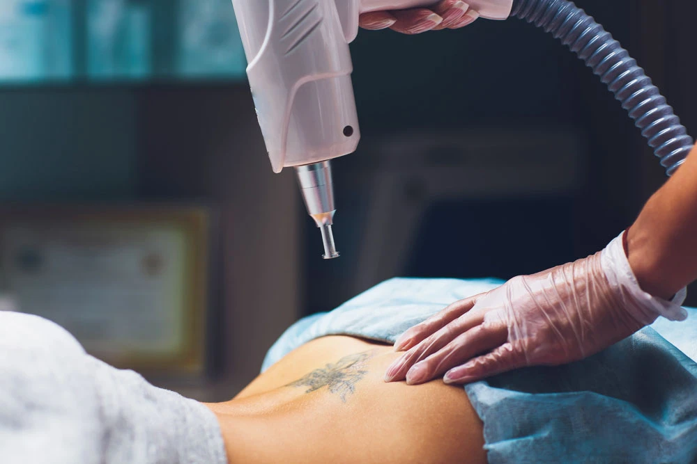 How to Choose the Best Tattoo Removal Treatment in Delhi