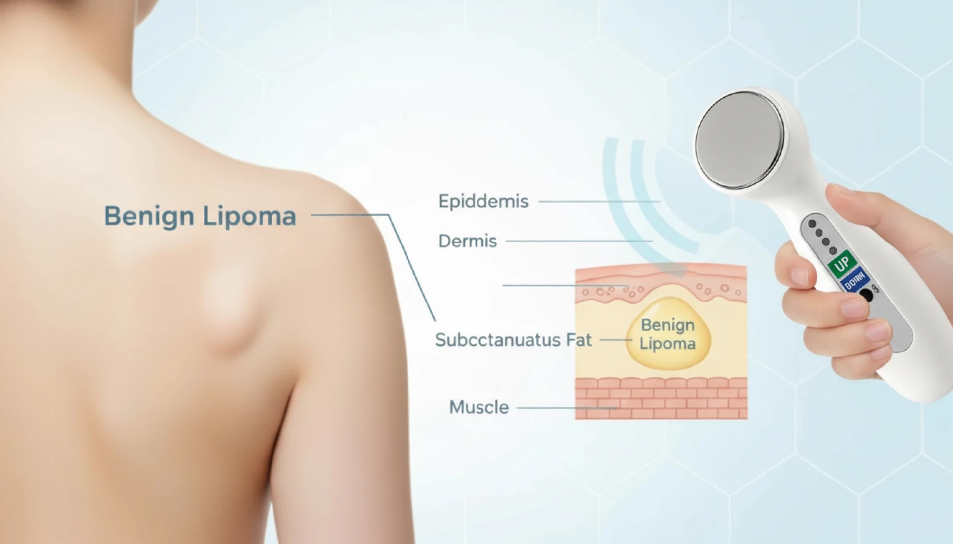 Benign fatty lipomas: understanding overgrown fat cells