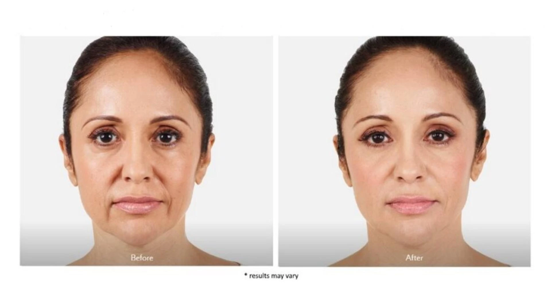 Juvederm Lip Augmentation: Achieve Natural, Beautiful Lips with Confidence