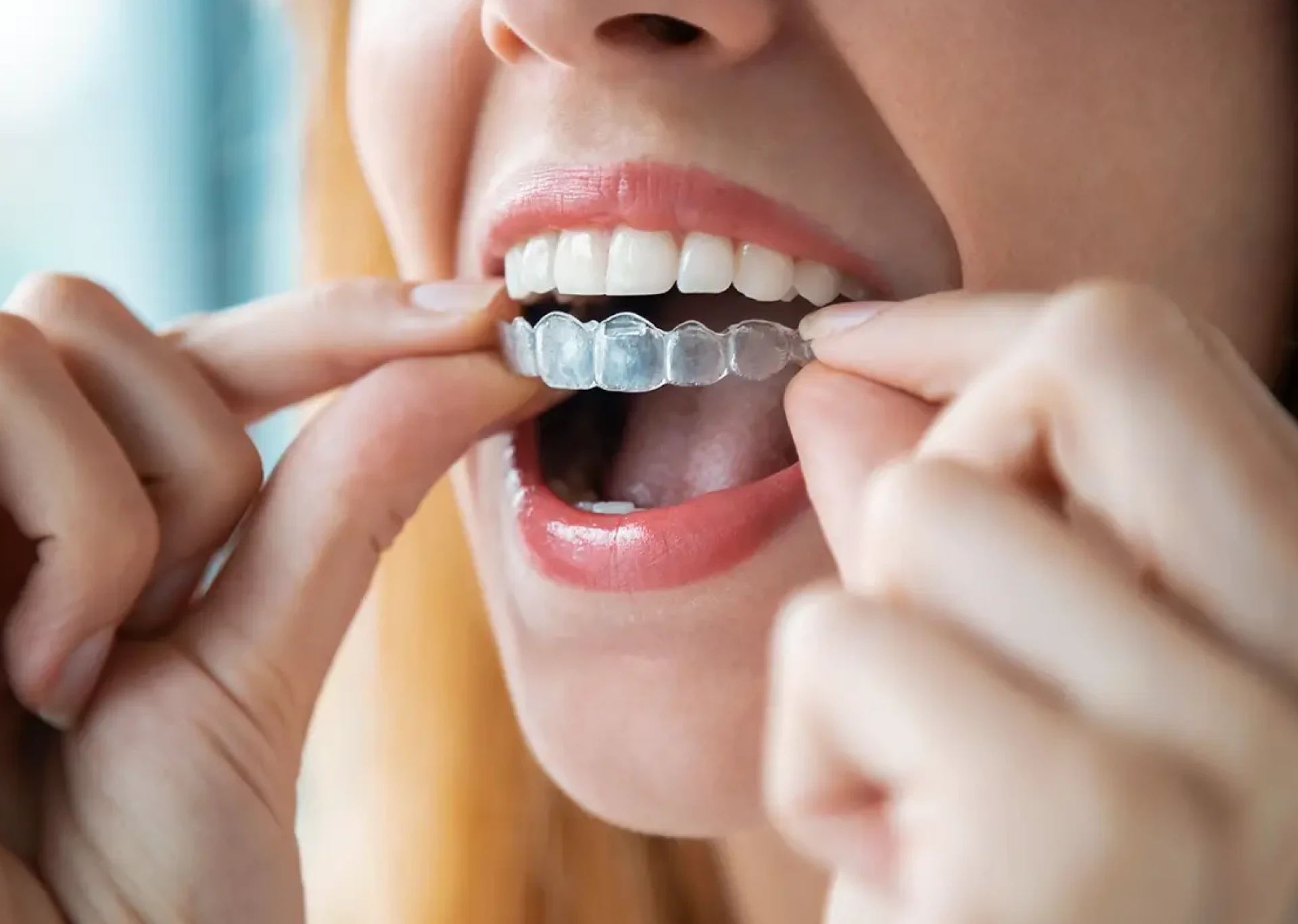 How Much Do Braces Cost? & Which Clinic Provides Invisalign?