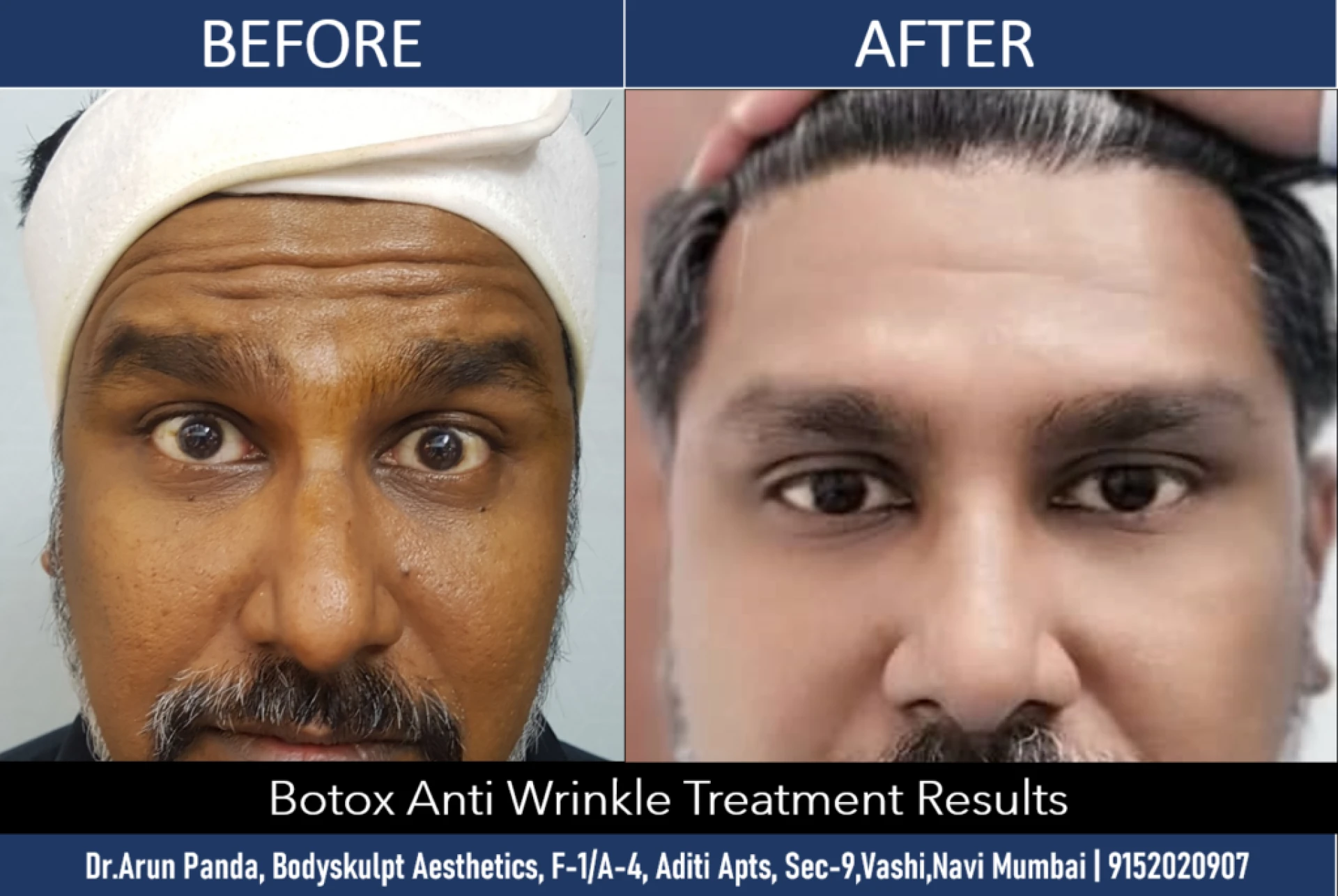 Botox or Buccal Fat Removal? A Complete Cost & Results Comparison in Mumbai