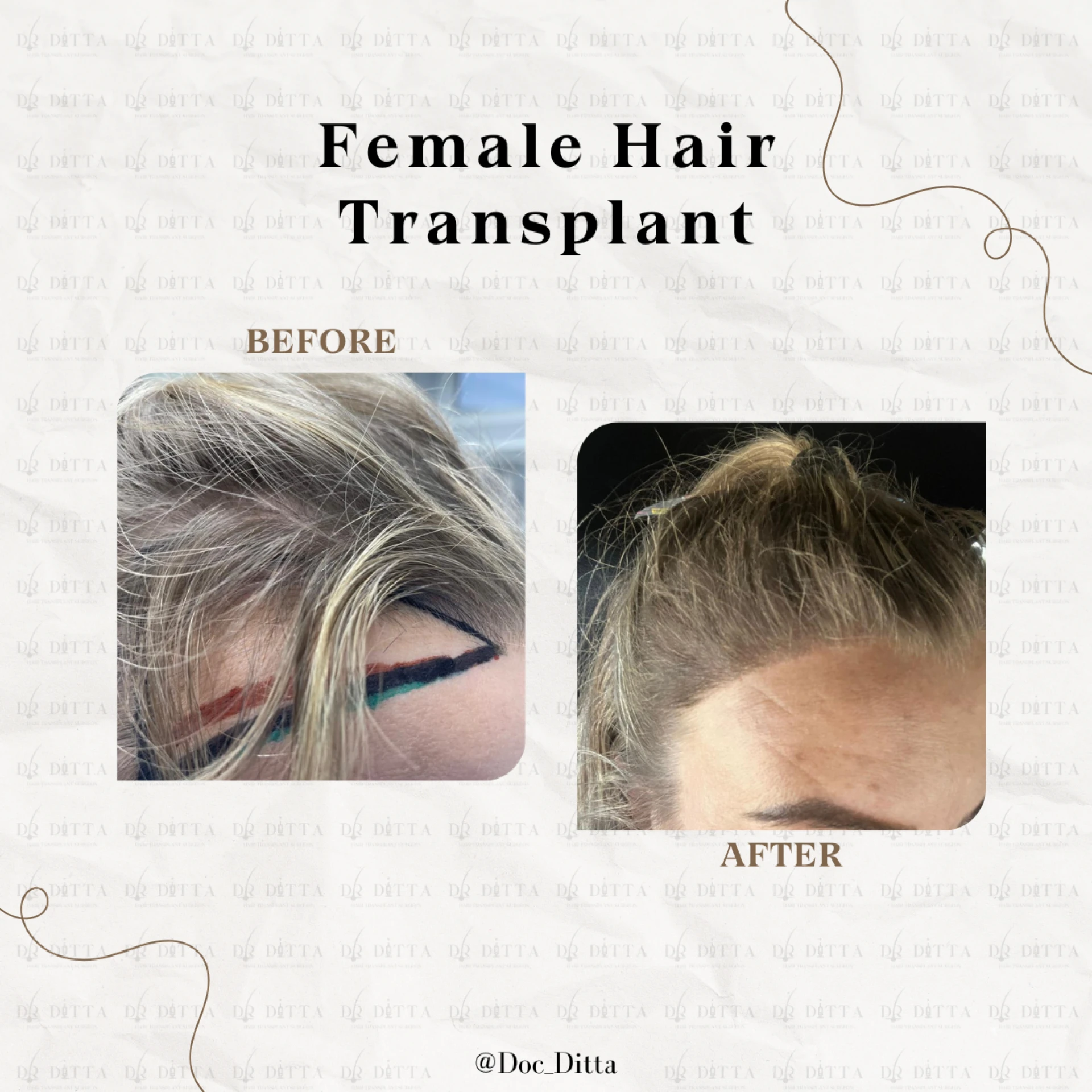 DHI Hair Transplants: Demanding Services in the UK Marketplace