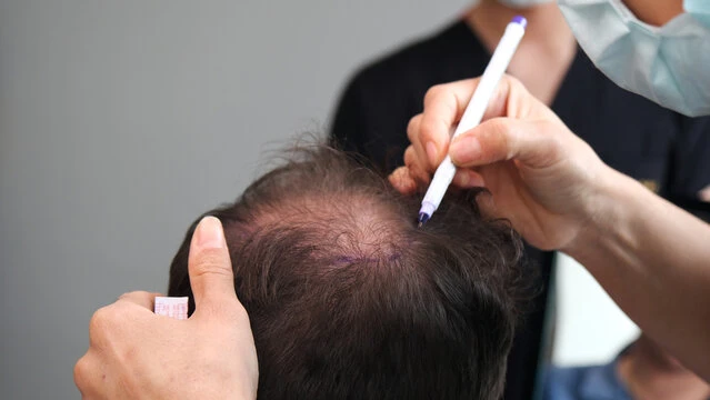 Hair Transplant Myths Debunked by Experts