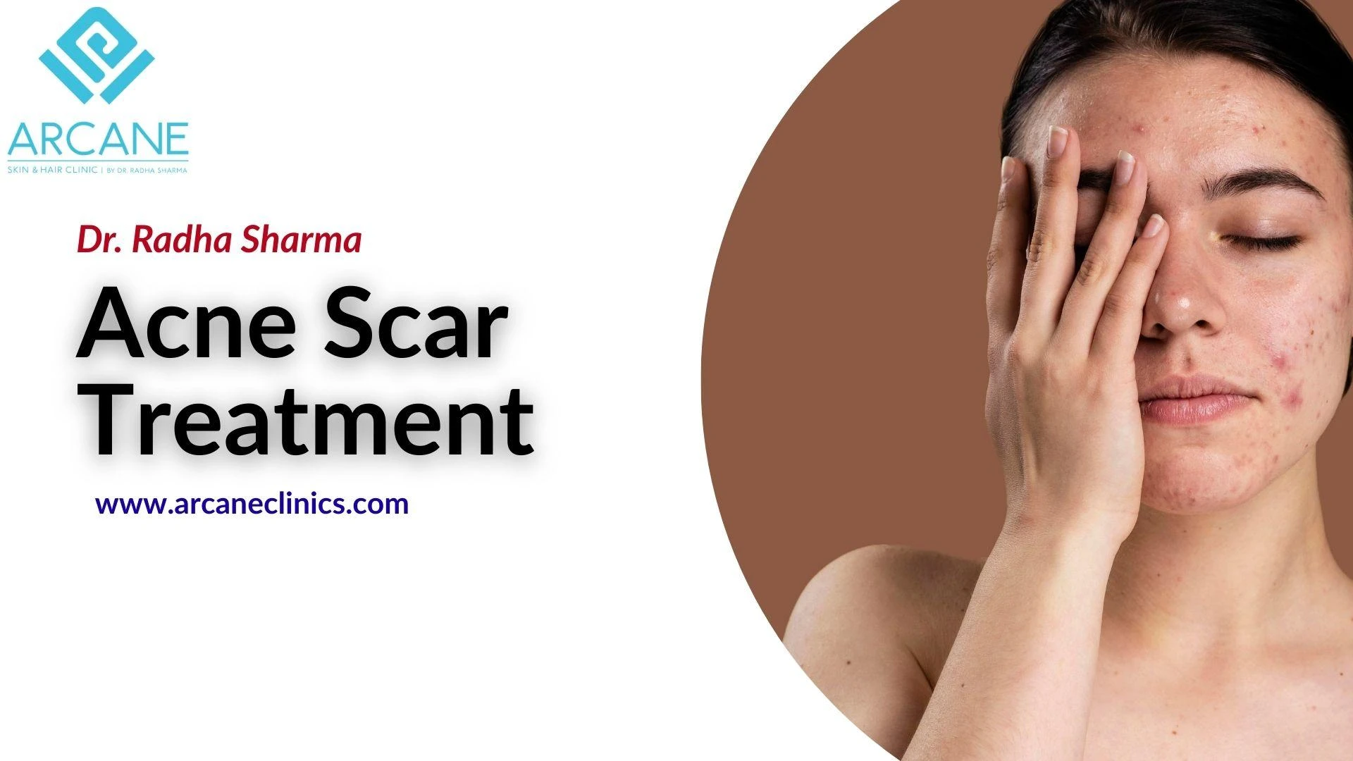 How Many Sessions Are Needed for Acne Scar Treatment?