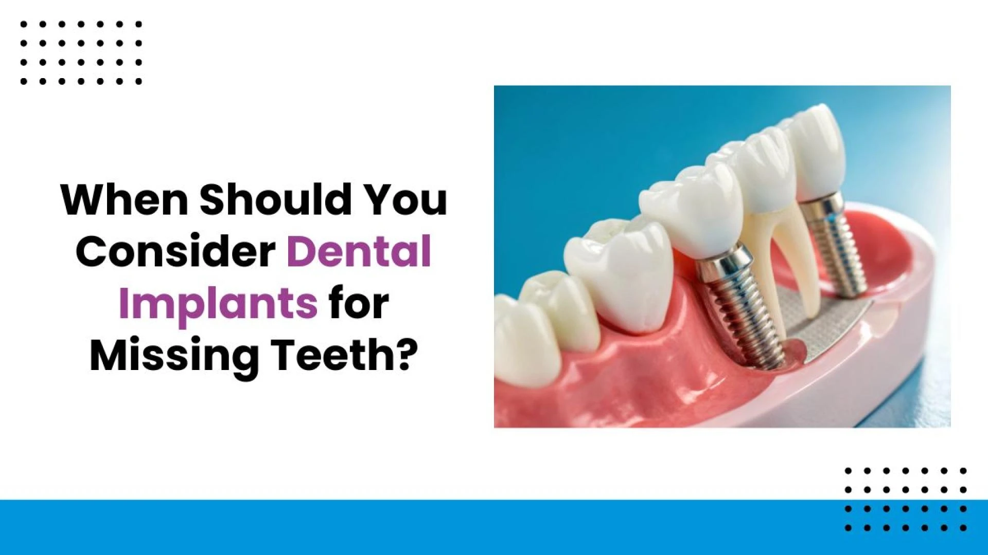 When Should You Consider Dental Implants for Missing Teeth?