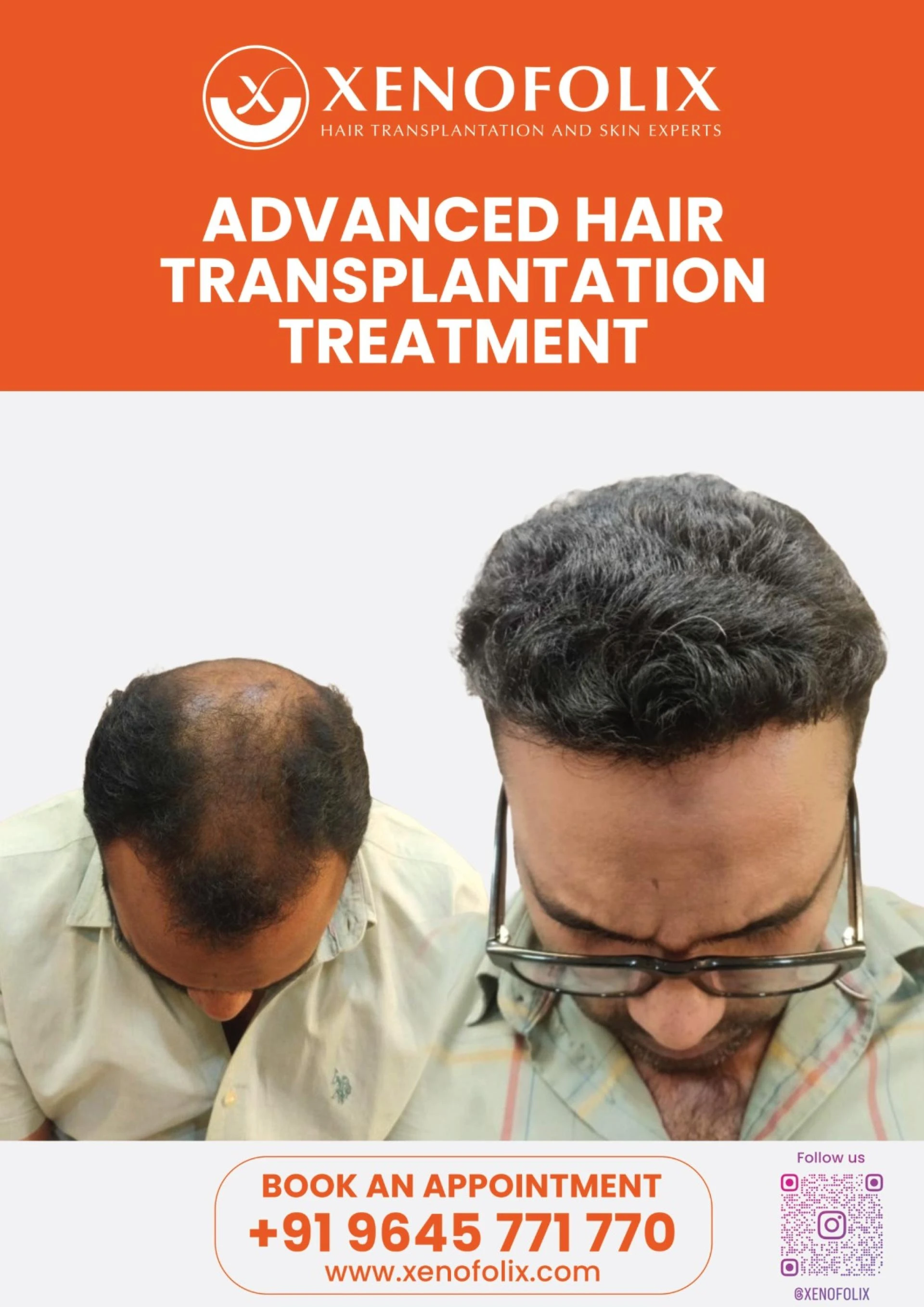 The Hair Transplant Question Most People Ask Too Late