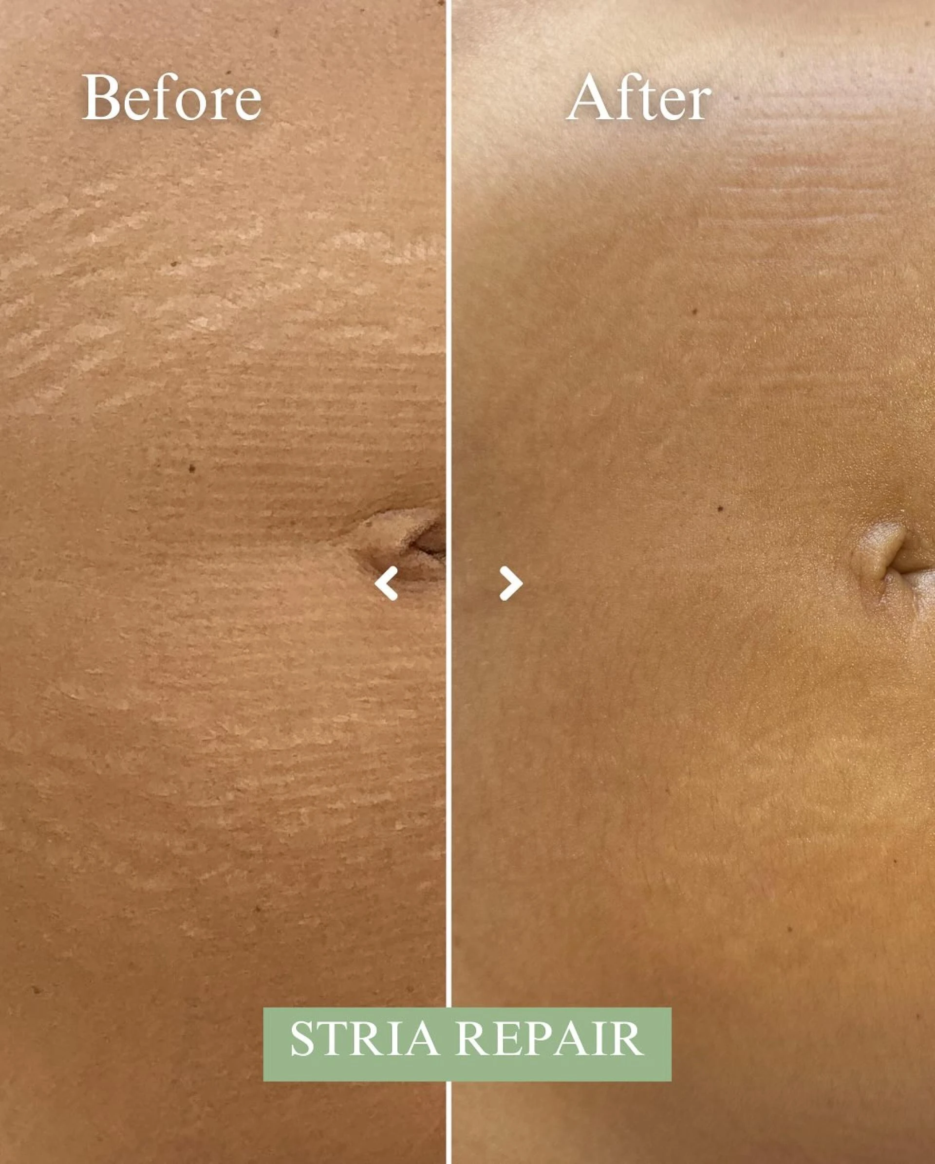 How Does Stretch Marks Removal Treatment Work?