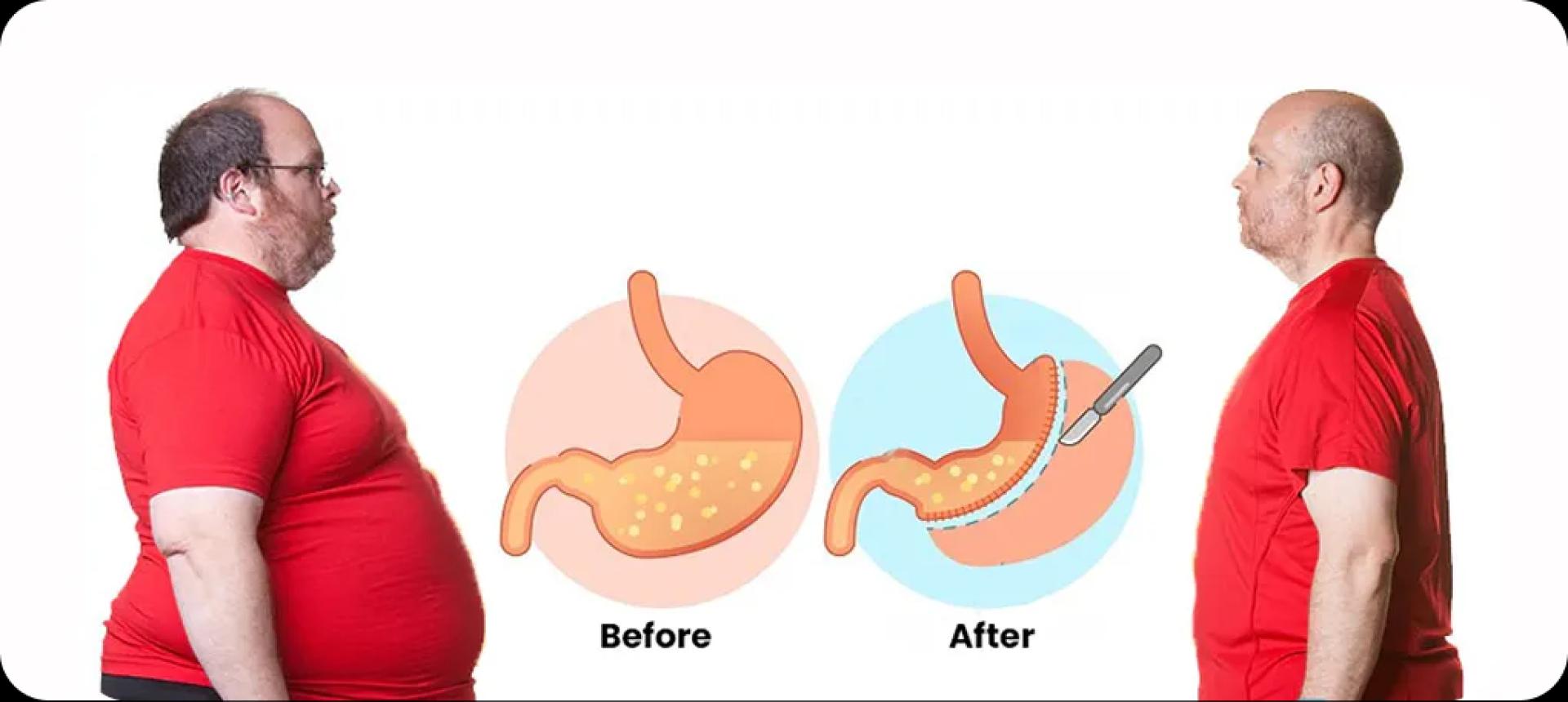 Bariatric Surgery: Types, Benefits, Recovery & Who Really Needs It