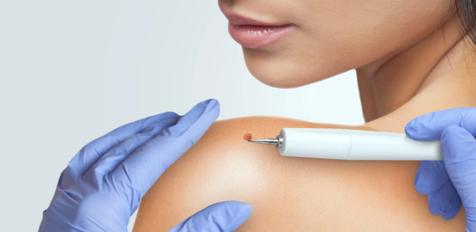 How Safe and Gentle Is Skin Tag Removal in Dubai Today?