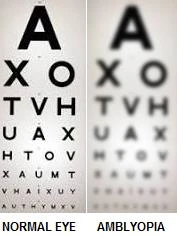 A Complete Guide to Selecting the Best Eye Surgeon in Gurgaon for Your Eye Health