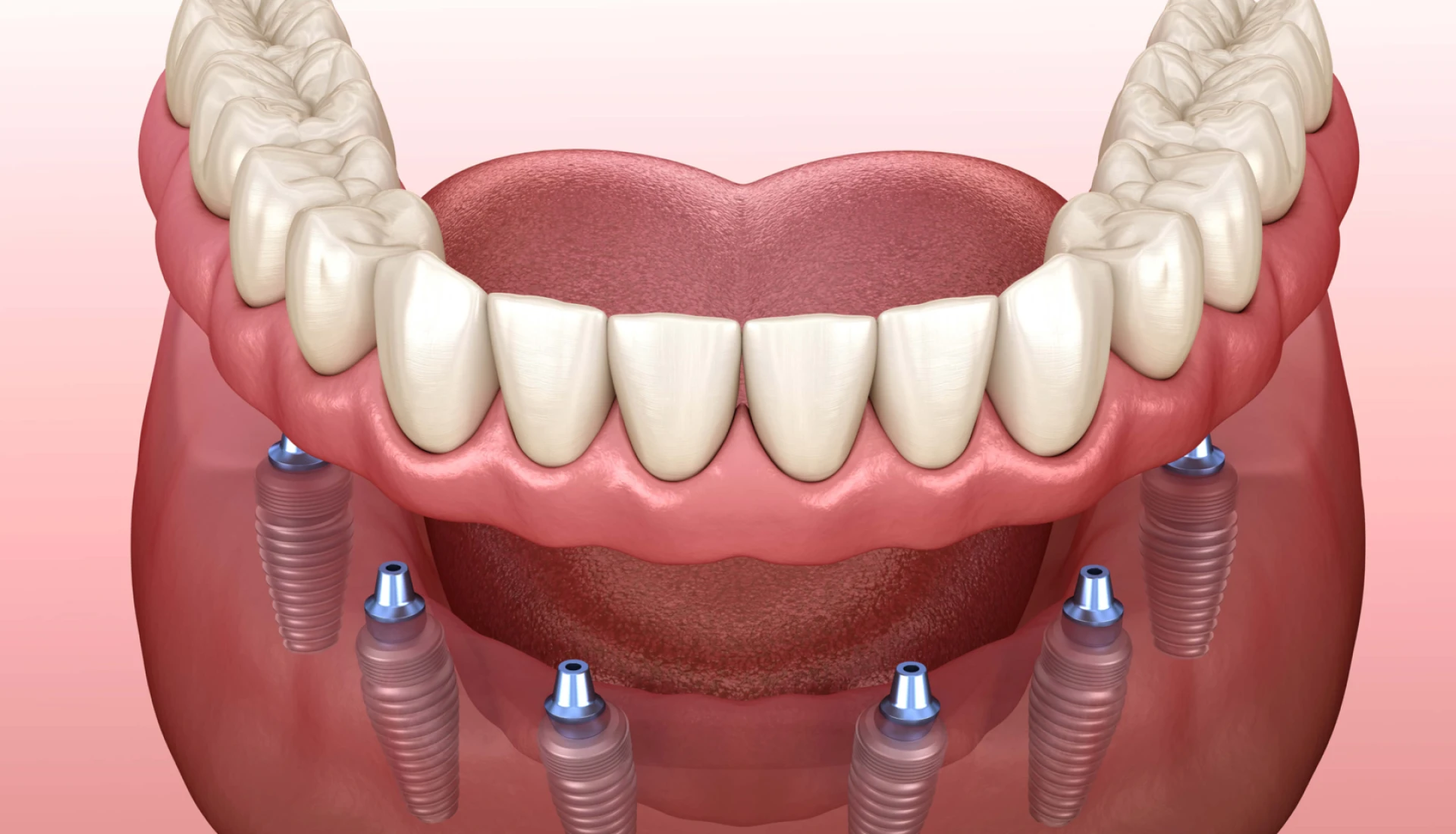 Implant-Supported Dentures in Fayetteville NC for Lasting Comfort and Confidence