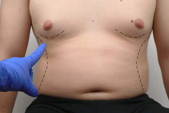 Does Gynecomastia Surgery Leave Scars?