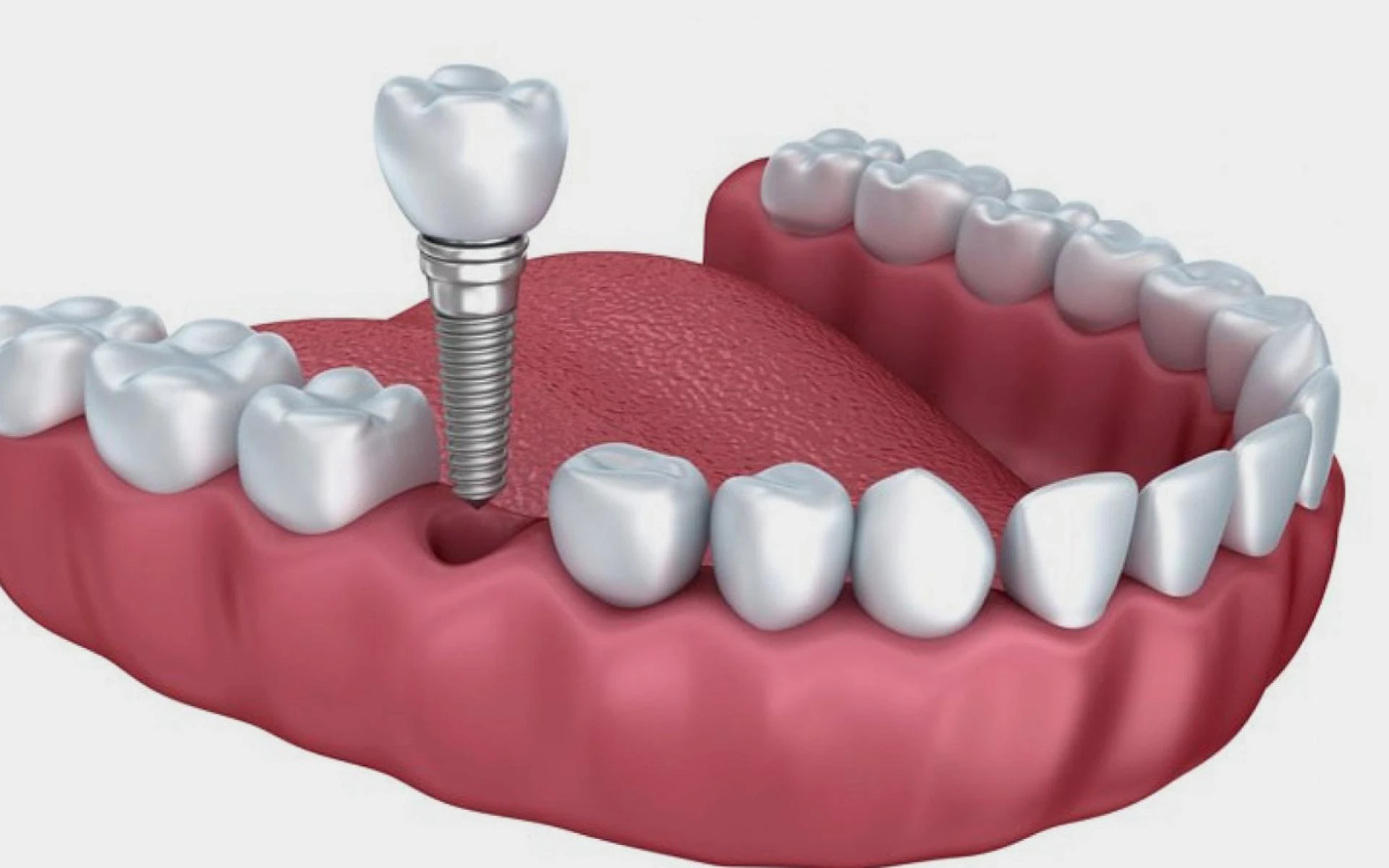 Root Canal Treatment in Panchkula: What to Expect
