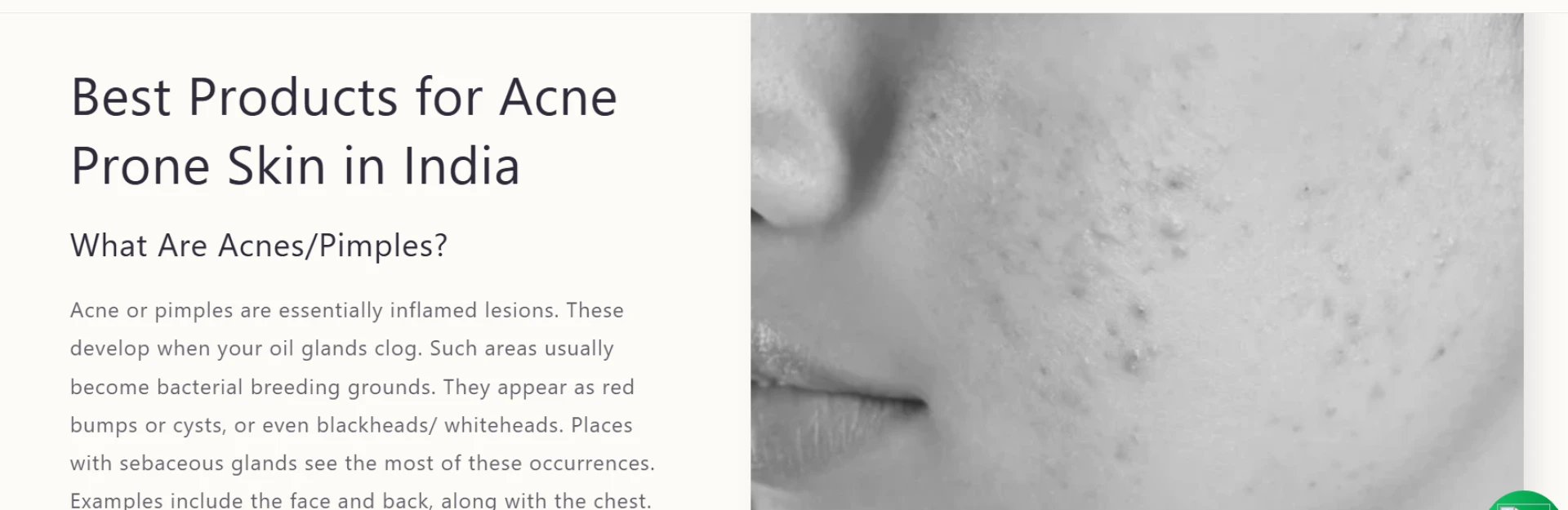 Best Products for Acne Prone Skin in India | Derma recommended skincare brand