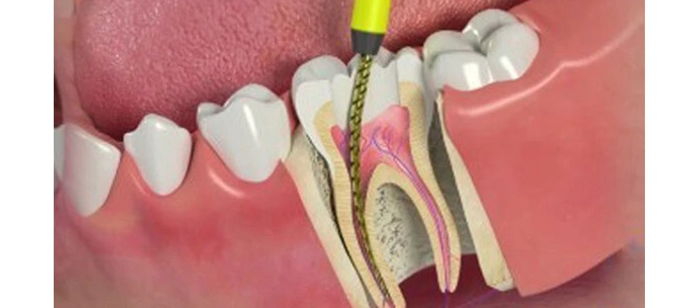 Root Canal Treatment Dubai – Comprehensive Guide with Dental Home