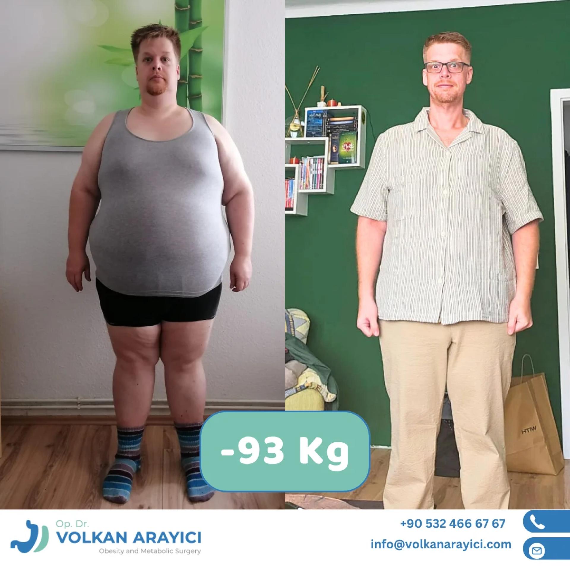 Gastric Sleeve Turkey Price Guide: Affordable Options for 2026