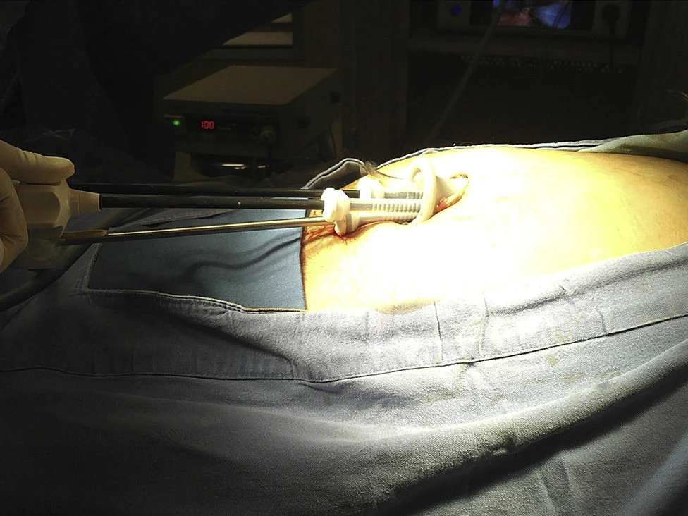 What is Laparoscopic Liver Abscess Drainage?