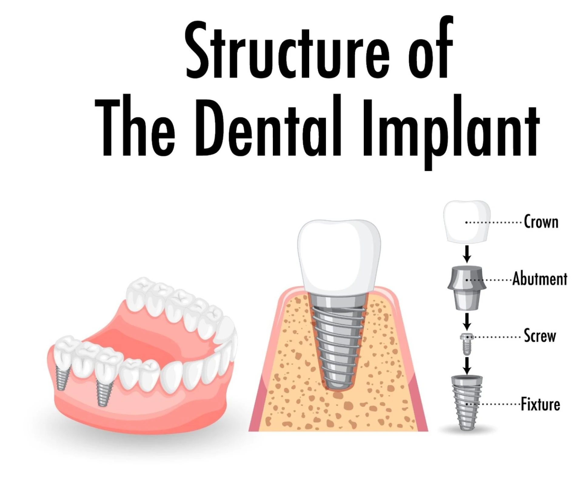 Dental Implants: What You Should Know