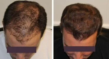 The Best Reasons to See a Hair Loss Specialist Near You