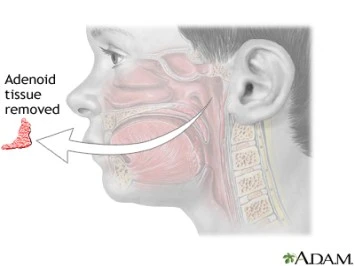 Adenoid Surgery Cost and Effective Adenoids Treatment: What You Need to Know