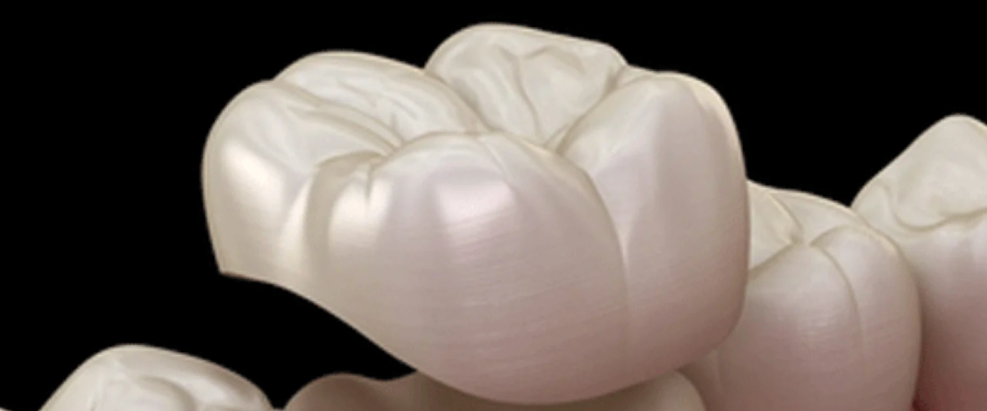 Cost of Dental Crowns in India – A Complete Guide