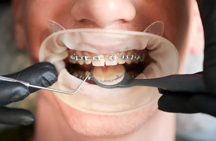 Discover the Best Orthodontic Care in Monett MO with Braces and Invisalign