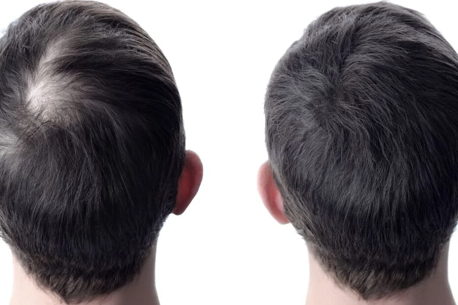 Alopecia and Hair Restoration Treatments