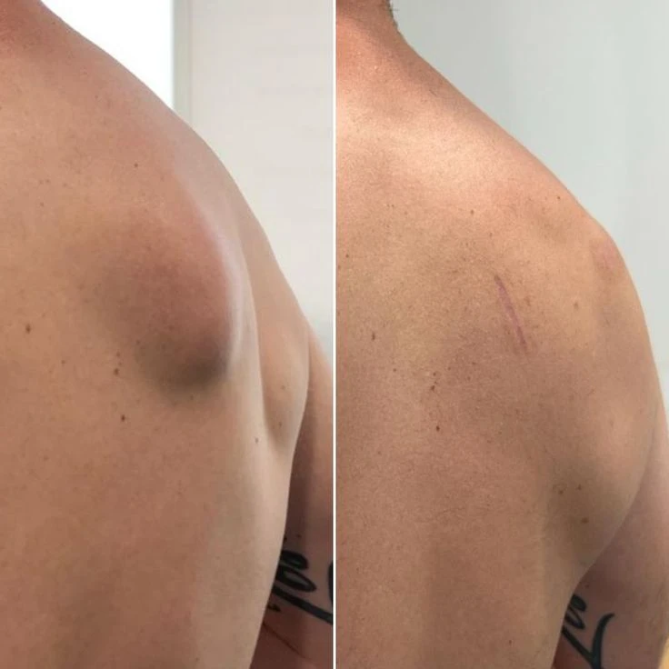 How to Remove Lipoma Naturally