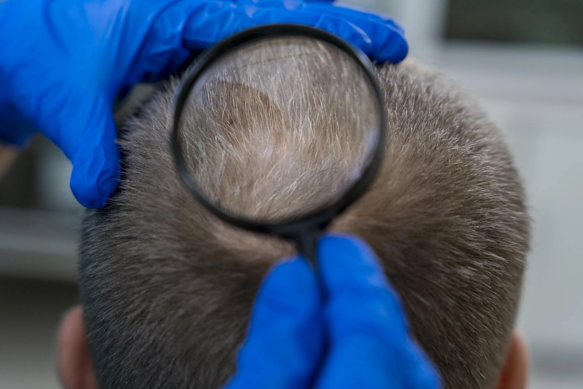 Understanding Laser Phototherapy for Hair Growth: Insights from Real-User Experiences